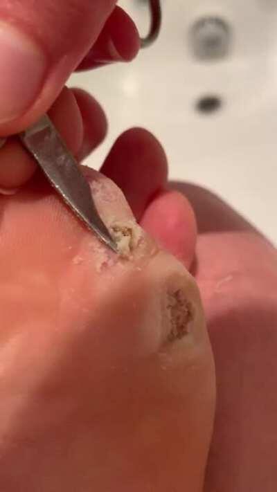 Debriding outer layer of wart skin- thought you guys might like to see this. Have been going at it with the ACV and duct tape for 1.5 weeks now and this is my fourth debriding session. Starting to feel like I’m actually making progress!
