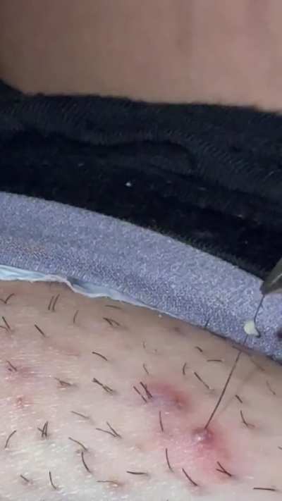 Ingrown hair pt 2