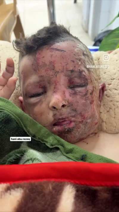 this little boy last his arm and his entire family all thanks to israeli air strikes. is this a hamas member?