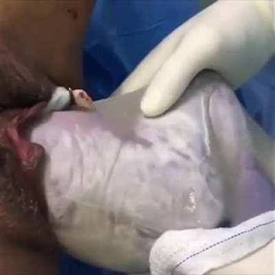 Twin B born en-caul and breech