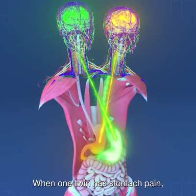 Two Heads, One Body: Anatomy of Conjoined Twins