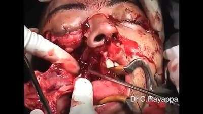 Midfacial Split
