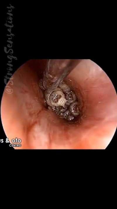 In the ears. I can’t watch, but I know it belongs here.