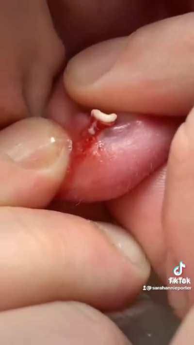 A classic. Earlobe infection!