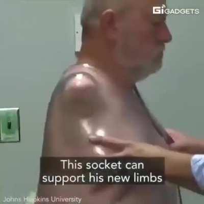 A few years ago, this man made history by becoming the first bilateral shoulder-level amputee to simultaneously control two Prosthetic Limbs... With his mind!