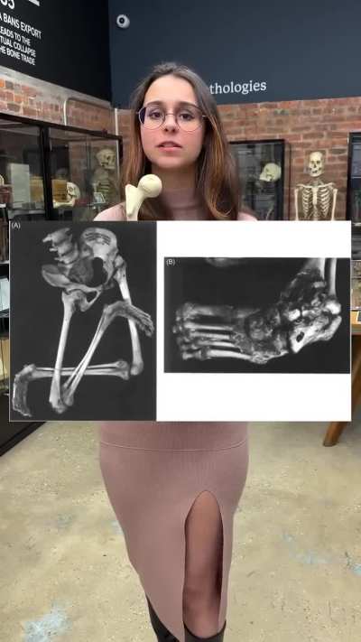 How polio affects bone development