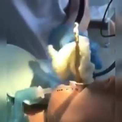 Doctor removed a 4 feet snake out of woman's mouth which crawled inside her while she fell asleep