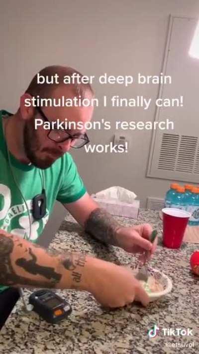 Positive effect of deep brain stimulation to a person with Parkinson's.