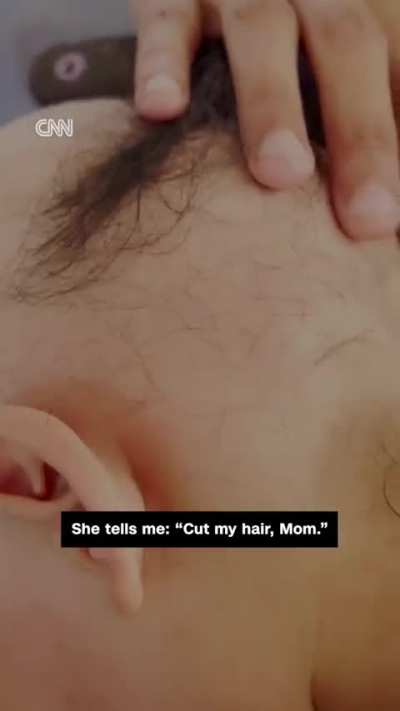 Eight-year-old Sama Tubail lost all of her hair due to the constant trauma she has endured from Israel's genocide in Gaza