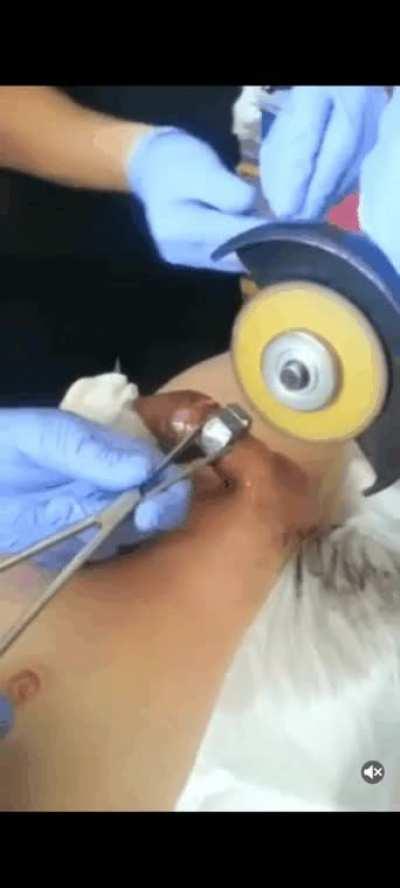 he put his dick in a nut and now has to get it surgically removed