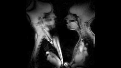 Kissing In MRI?