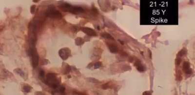 Spike protein from the covid vaccine has entirely replaced their sperm