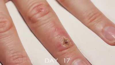 Как заживает рана