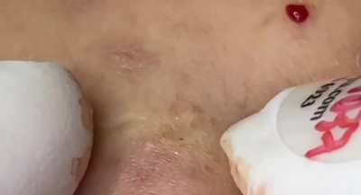 Blackheads