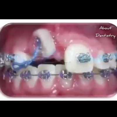 Orthodontic treatment timelapse