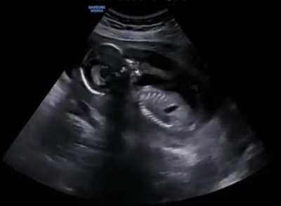 Ultrasound of a pregnant woman laughing