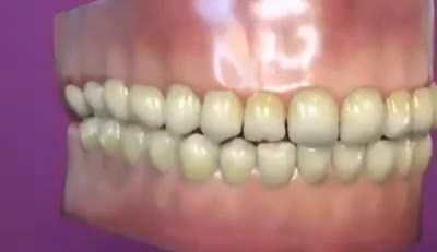 Thanks, i hate inflatable teeth