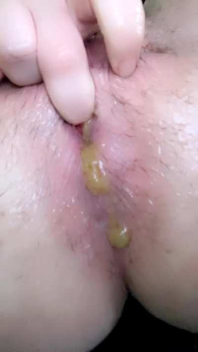 nasty prolapse 