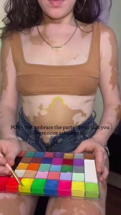 After a decade, I’ve finally been able to embrace my skin 🫶🏼 vitiligo is something that makes me stand out, and I’m okay with that!