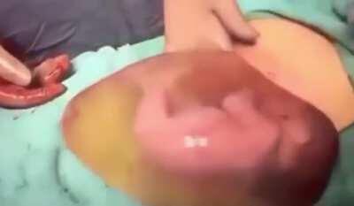 A baby moving around in an anmiotic sac