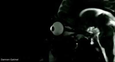 X-ray of what happens to your eye ball when you rub them.