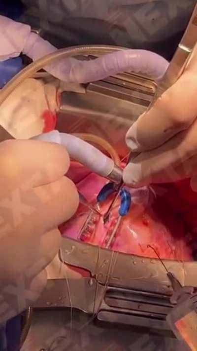 Doctor performs open heart surgery to remove a bullet lodged in the heart of a Ukrainian soldier in Feofaniya hospital, Kyiv. He made a full recovery