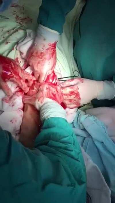 A male patient has an impressively-massive foreign body removed