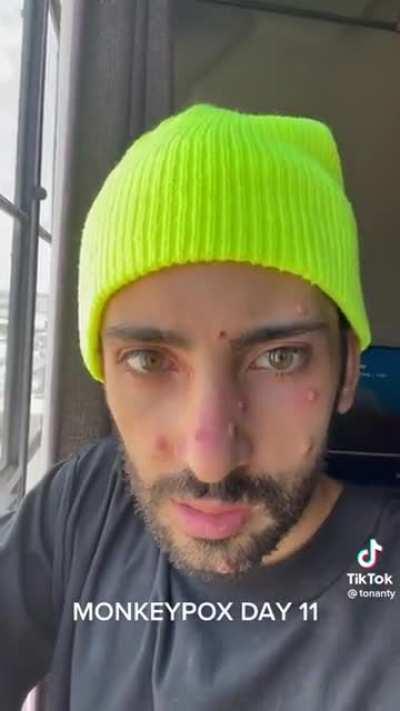 What someone with monkeypox looks like...