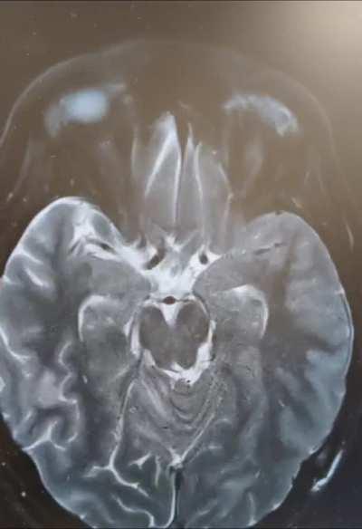 52yo male. Metastatic melanoma to brain. Discharged to hospice. 