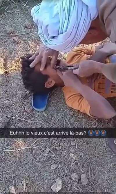 Teeth removal hard-mode