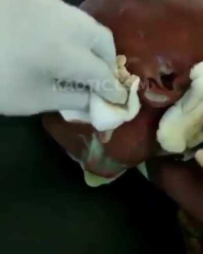 So many, many things wrong medically with this one. Shame on the doctor, nursing staff, anyone else involved with no pain management, surgical skill, even basic decency regarding a clearly suffering patient. Ugh.