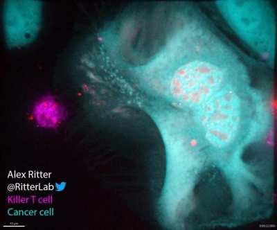 Killer T cell of the immune system destroying a monstrous ovarian cancer cell (Credit: Alex Ritter)
