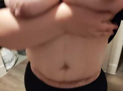 Confident showing my scar from skin removal