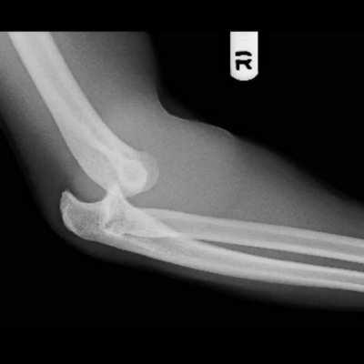 Instant dislocated shoulder