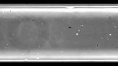 The 1st pregnancy via A.I. detected sperm (by finding 5 motile sperm in 2.5 million images) from a 39-year-old man with infertility.