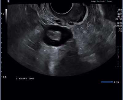 Is my pcos bad or could it be way worse ? 
