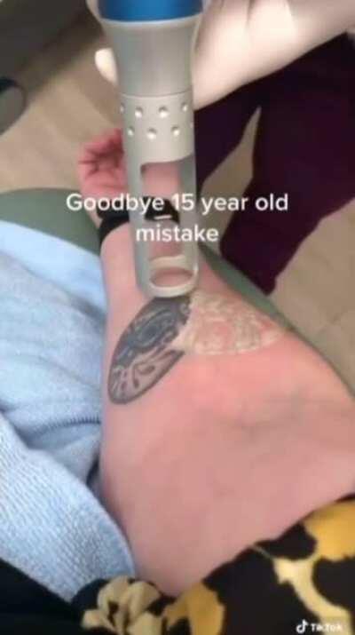 Laser Tattoo Removal Best Goes HARD!