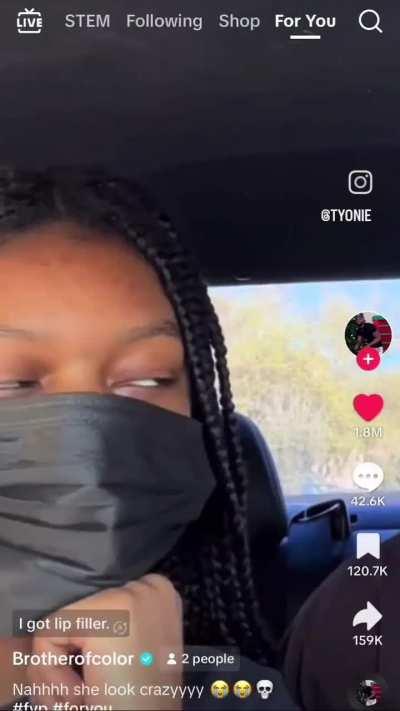 Lip Filler gone wrong