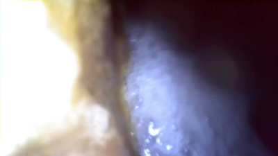 Swallow a pair of headphones wrapped in plastic wrap to record, my endoscopic video finally has a real ambient sound!!!