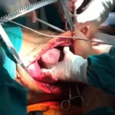 Open cardiac massage and resuscitation with thoracotomy