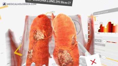 3D Medical Imaging of post covid lungs in VR.
