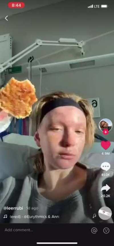 Not cringe. But does anyone know what happened to this girl who has been documenting her burn recovery?