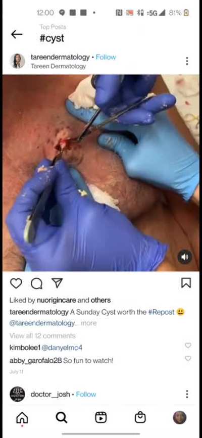big ol' cyst on a big ol' man titty!