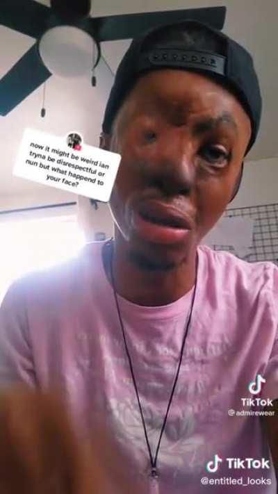 TikToker speaks about being mauled by two pit bulls when he was eight years old.