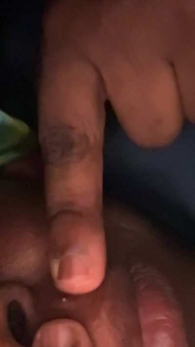 2 upper lip pimples :)