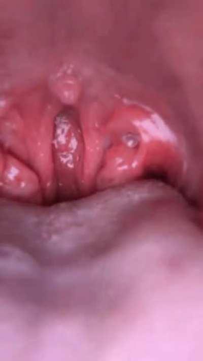 Up close and personal with my uvula 😌