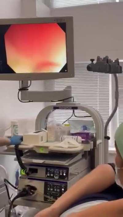 Cucumber removed from Anus Cavity