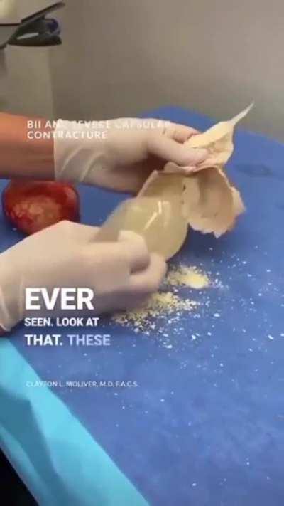 Woman tits implant after chronic inflammation 