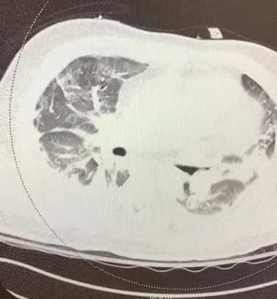 “Recovered” from CV19