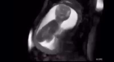 One of the clearest images of human baby inside womb using MRI.. thank god we don’t remember what it was like in womb cause it looks uncomfortable and claustrophobic.. but also amazing!